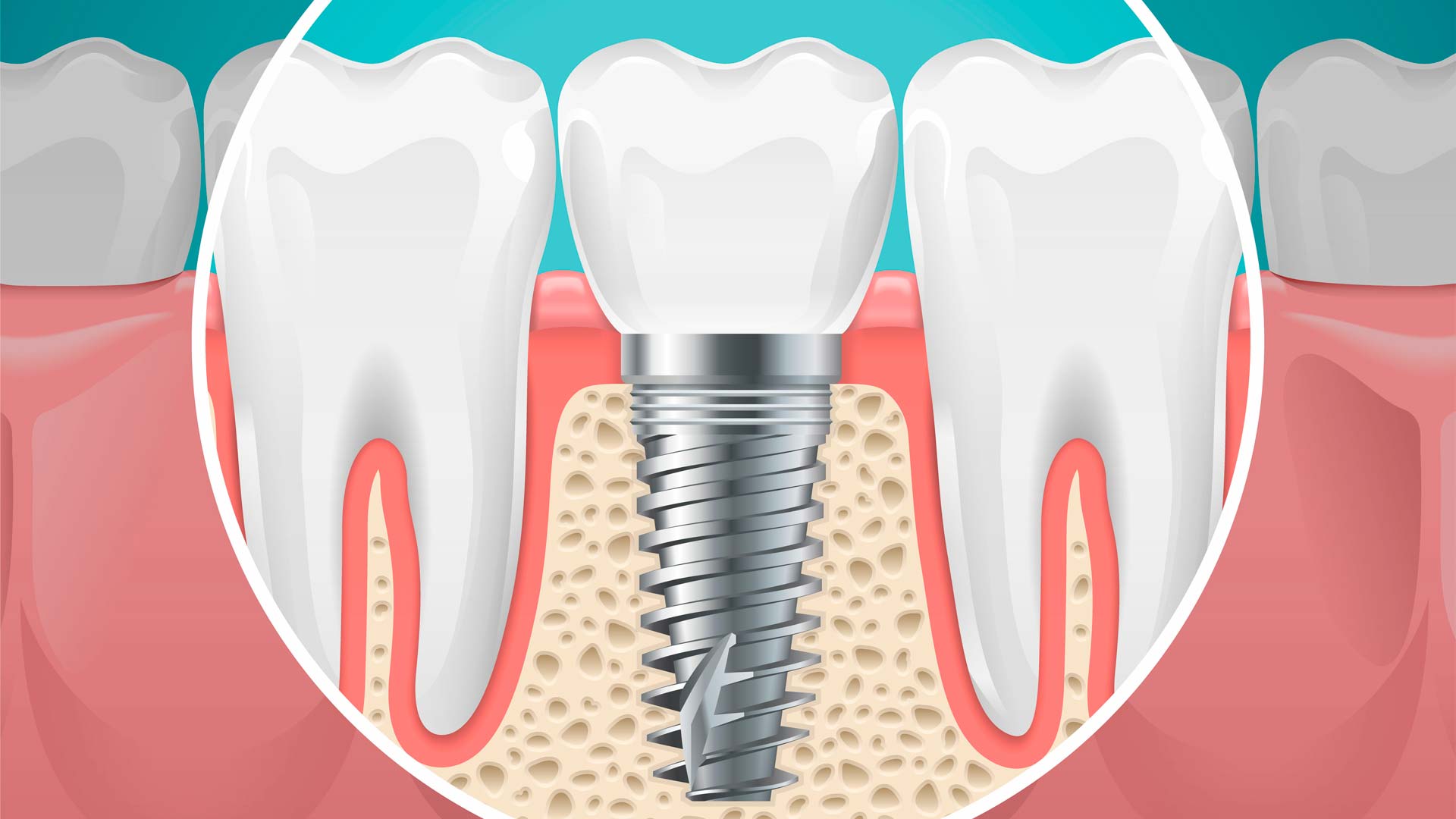 Implantología bucomaxilofacial